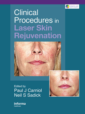 cover image of Clinical Procedures in Laser Skin Rejuvenation